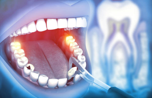 Smart Approaches to Wisdom Tooth Extraction for Active Lifestyles Tooth Extraction for Active Lifestyles